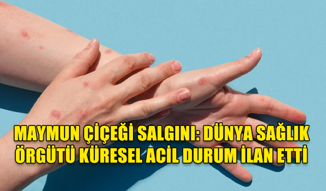 MAYMUN ÇİÇEĞİ SALGINI: DÜNYA SAĞLIK ÖRGÜTÜ KÜRESEL ACİL DURUM İLAN ETTİ