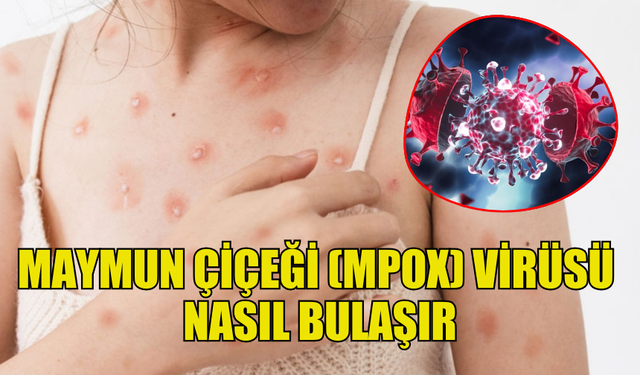 MAYMUN ÇİÇEĞİ (MPOX) VİRÜSÜ: BİLİNMESİ GEREKENLER