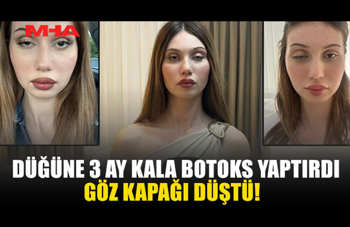 DÜĞÜNÜNE 3 AY KALA BOTOKS YAPTIRAN KADININ GÖZ KAPAĞI DÜŞTÜ