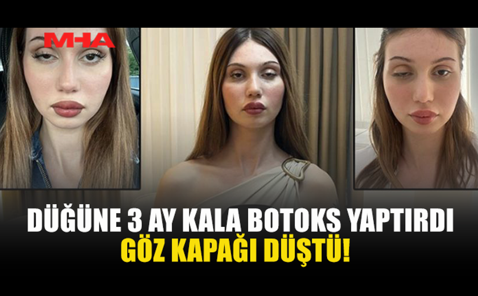 DÜĞÜNÜNE 3 AY KALA BOTOKS YAPTIRAN KADININ GÖZ KAPAĞI DÜŞTÜ